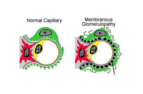 Membranous glomerulonephritis .
